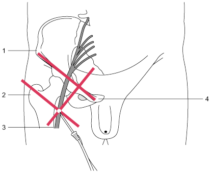 sciatic nerve block anterior approach